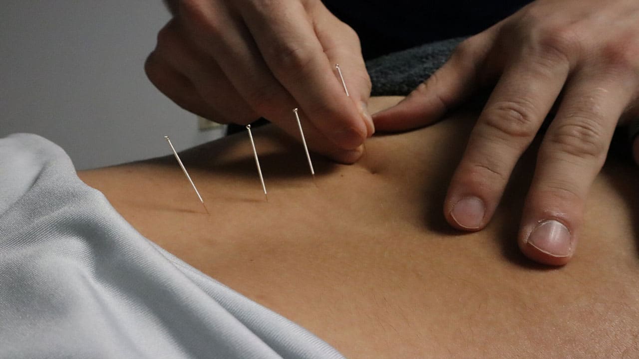 طب سوزنی برای دیسک کمر | مزایا، نحوه درمان و میزان اثربخشی