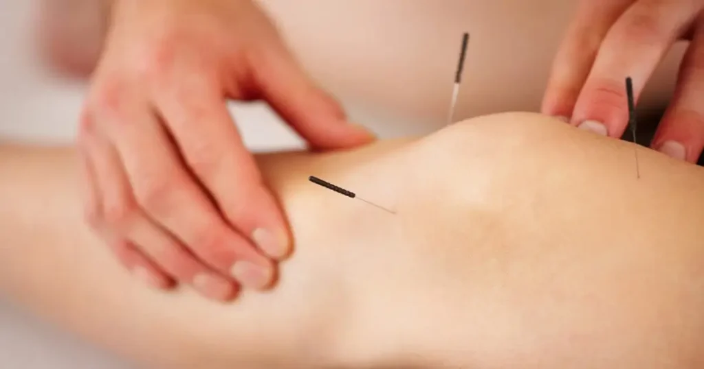 طب سوزنی چیست؟