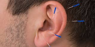 طب سوزنی گوش ؛ کاربرد ، مزایا و معایب آن