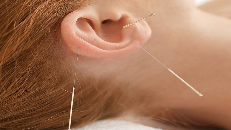 مزیت ها و کاربردهای طب سوزنی گوش