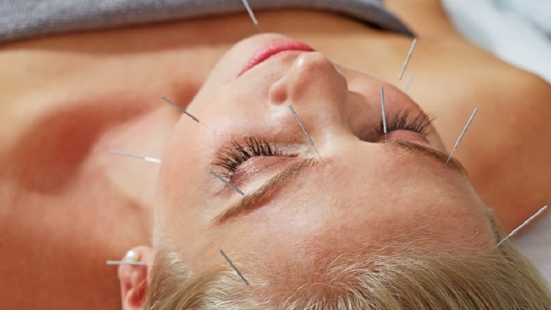 طب سوزنی برای میگرن | مزایا، نحوه درمان و میزان اثربخشی