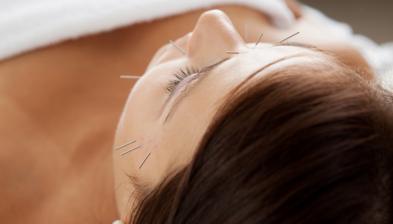 طب سوزنی برای میگرن و کاهش دردهای میگرنی